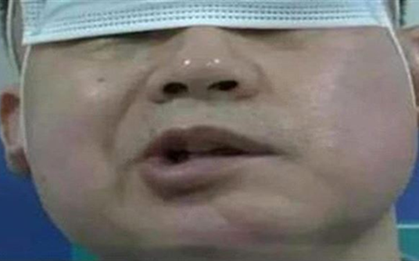 Bật điều hòa ngủ cho mát, người đàn ông bị liệt mặt, bác sĩ cảnh bảo thói quen yêu thích của người trẻ
