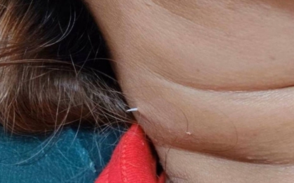 Đau cổ, người phụ nữ sốc nặng khi thấy thứ nhô ra ngoài