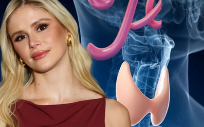 Sao phim "The Boys" tiết lộ mắc bệnh cường giáp khiến người hâm mộ lo lắng: Phụ nữ có nguy cơ cao mắc bệnh gấp 5 lần nam giới