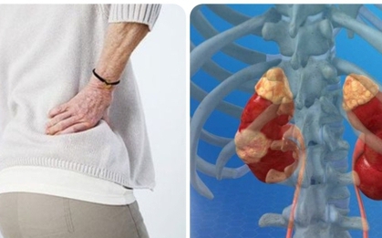 Triệu chứng ung thư thận giai đoạn cuối