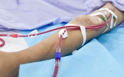Suy thận ở tuổi 32 sau nhiều năm lạm dụng sản phẩm tăng cơ