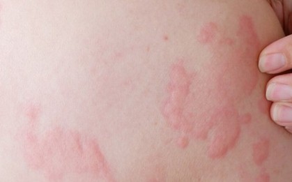 Bác sĩ chỉ ra sai lầm “chết người” về một căn bệnh mà nhiều người vẫn vô tư điều trị tại nhà