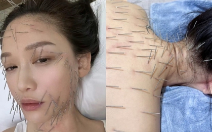 Sốc nặng hình ảnh Trần Kiều Ân cắm hàng trăm chiếc kim khắp cơ thể, làm đẹp mà chấp nhận đau đớn không tưởng!