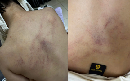 Vụ bé gái 4 tuổi bị đánh tím lưng: Đình chỉ thêm 1 giáo viên