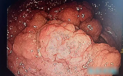 Người đàn ông suýt "mất hậu môn" vì khối u trực tràng