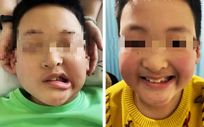 Bé trai 11 tuổi méo miệng do liệt dây thần kinh số VII, bác sĩ cảnh báo nguyên nhân thường gặp