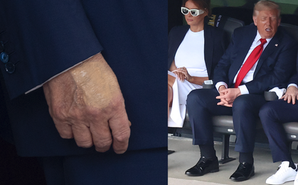 Nhà Trắng thông báo Tổng thống Donald Trump mắc suy tĩnh mạch mạn tính