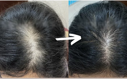 Cô gái 29 tuổi tóc đã rụng hói đầu, bác sĩ: Ngăn ngừa rụng tóc, kích thích mọc tóc cần tránh xa những thứ này
