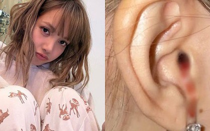 "Máu nhỏ giọt từ tai tôi", tiết lộ của Lisa (BlackPink) khiến nhiều người lo lắng: Chuyên gia chỉ ra nguyên nhân