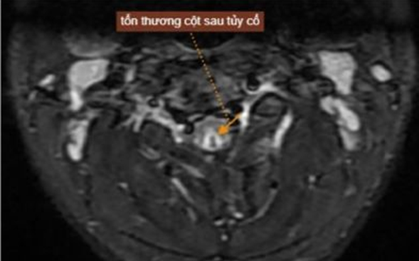 Hít 50 quả bóng cười mỗi lần suốt hơn 1 năm, nam thanh niên 20 tuổi tổn thương tủy sống