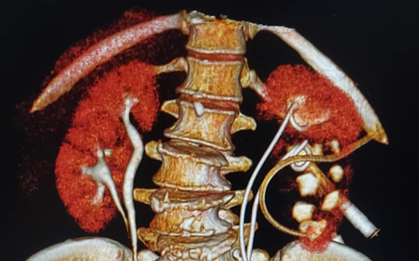 Hi hữu: Ra Hà Nội khám bệnh, người phụ nữ tình cờ phát hiện đã "chung sống" với 4 QUẢ THẬN trong suốt 65 năm