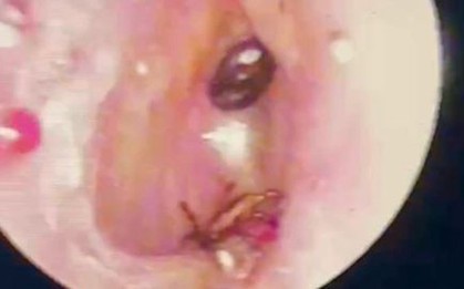 Nội soi tai bé trai 9 tuổi, bác sĩ phát hiện điều đáng sợ