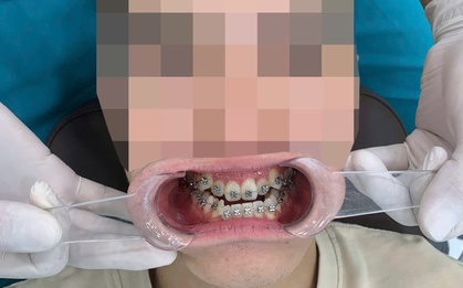 Trầm cảm vì niềng răng 3 năm vẫn "hô như ngày đầu"