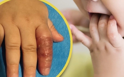 Mẹ dùng băng quấn để ngăn con mút tay, em bé suýt phải cắt cụt ngón