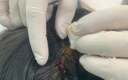 Bé gái 10 tuổi bất ngờ bị khỉ tấn công khi vào Rào Vịnh