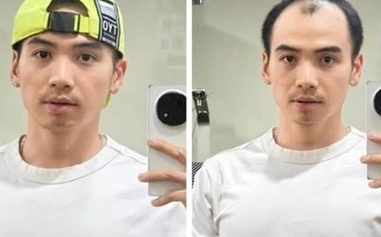 Chồng H'Hen Niê thay đổi thế nào sau cấy tóc trị hói đầu? Phương pháp này có giá bao nhiêu?