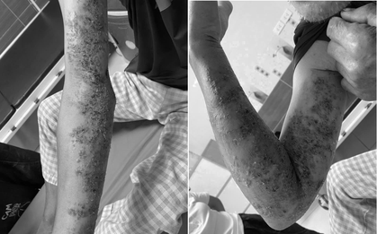 Cánh tay người đàn ông đầy mụn nước vỡ, chảy dịch mủ bốc mùi vì chủ quan với bệnh