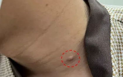 Mụn lâu lành biến thành ung thư