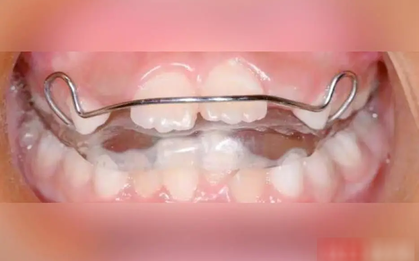 Bé gái 8 tuổi răng hô, môi trên vểnh, cằm nhỏ, trí tuệ giảm vì một thói quen xấu khi ngủ