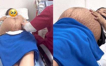 Xót xa hình ảnh chiếc bụng rạn nứt chằng chịt như dưa bở của mẹ bầu thai đôi ở tuần thứ 36