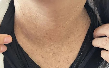 Uống thuốc chữa táo bón suốt 2 năm, người phụ nữ ngộ độc chất asen cực độc mà không biết!