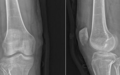 Cô gái 21 tuổi mắc "hội chứng búp bê sứ"