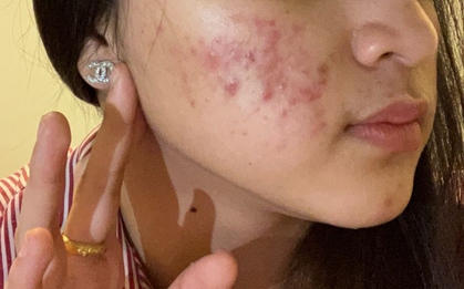 CẢNH BÁO: 4 kiểu mụn rất dễ là "lớp ngụy trang" của bệnh ung thư nhưng ít người để ý