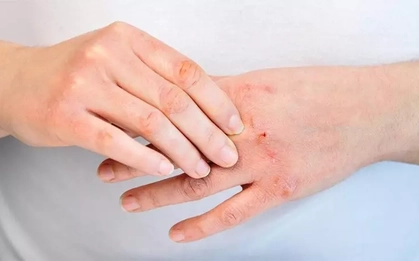 Mưa bão, lụt lội: Cẩn trọng với nguy cơ bỏng và mắc các bệnh về da