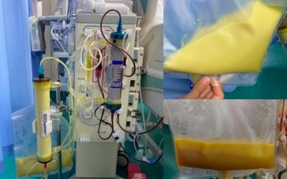 Máu trắng đục như sữa sau khi uống 3 cốc đồ uống này mỗi ngày: Nhiều người mê mẩn