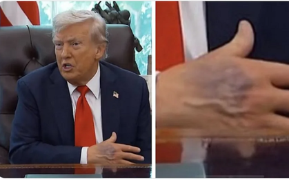 Bàn tay thâm tím của ông Trump gây chú ý