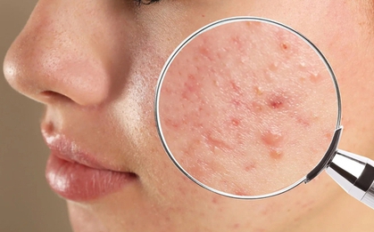 Ăn càng nhiều 5 thực phẩm này, đừng hỏi vì sao mụn "đua nhau" tìm đến