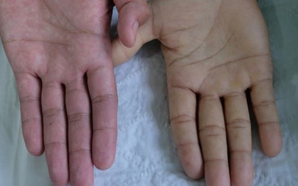 Một bệnh lý nguy hểm không chừa một ai: từ trẻ em, phụ nữ đến người làm văn phòng!