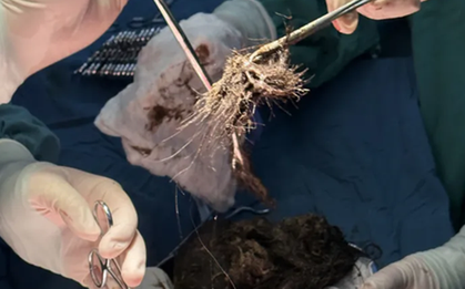 Thiếu nữ 15 tuổi nặng 35kg nhưng có tới "4kg là tóc" trong dạ dày