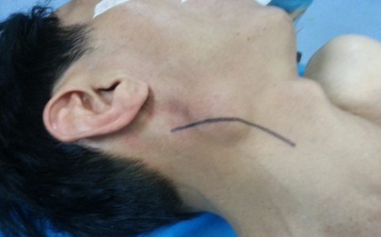 Loại ung thư có thể xuất hiện ở bất cứ vị trí nào trên cơ thể, không để ý 5 dấu hiệu này dễ "hối không kịp"