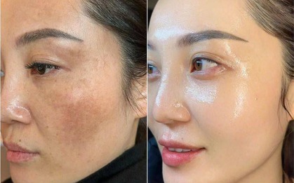 Sai lầm tồi tệ khi dùng Retinol suýt banh mặt, từ đáy lòng khuyên bạn đừng dẫm vào "vết xe đổ" này