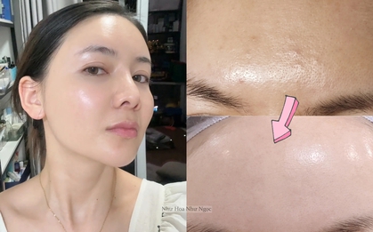 Thạc sĩ 36 tuổi chia sẻ hành trình trị mụn ẩn khoa học: Da sần sùi hóa láng mịn chỉ nhờ hiểu đúng