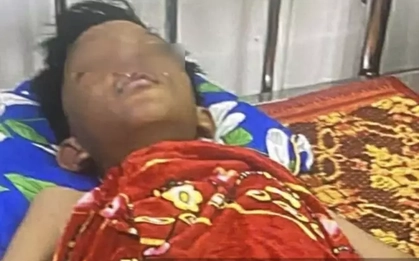 Vật lạ phát nổ, một học sinh lớp 6 bị bỏng nặng