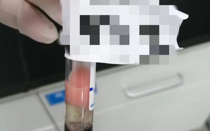 Máu biến thành “sữa dâu tây”, chàng trai 24 tuổi bị gọi gấp trở lại bệnh viện