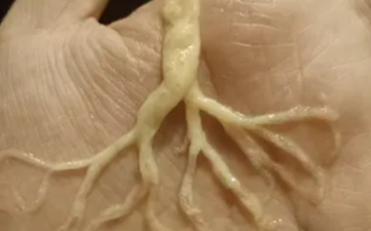 Người phụ nữ ho ra "rễ cây"