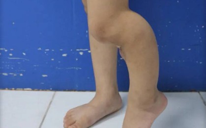 Bé gái 5 tuổi gãy xương đã được bó bột, bố mẹ vẫn khoét lỗ trên bột để đắp lá khiến xương không thể liền