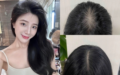 Tóc từng rụng không kiểm soát, người phụ nữ này đã "hồi sinh" từng sợi bằng thói quen đơn giản