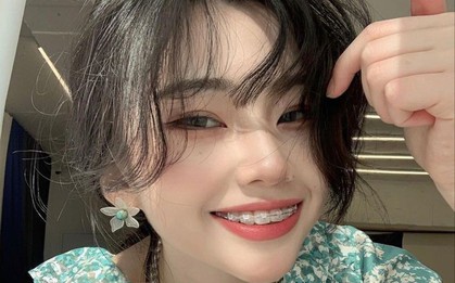 Niềng răng sai cách: Gây lệch mặt, sưng hàm, đau khớp