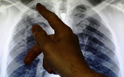 Khám cho nam thanh niên 26 tuổi bị ho dai dẳng, bác sĩ sốc nặng khi phát hiện "bí mật đáng sợ"