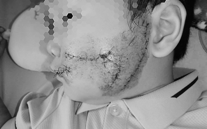 Cháu bé 5 tuổi ở Bắc Ninh bị chó cắn rách toang mặt khi đang chơi tại sân nhà