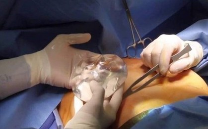Thiếu nữ 14 tuổi tử vong sau phẫu thuật nâng ngực