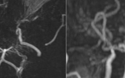 Hình ảnh MRI khiến bác sĩ bất ngờ: Mạch máu não bệnh nhân mờ như "khói thuốc"
