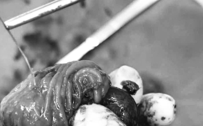 Người đàn ông 33 tuổi đau bụng, bác sĩ gắp ra "thứ đáng sợ" bên trong