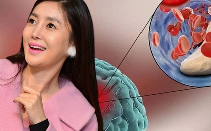 Nữ ca sĩ chia sẻ cơn ác mộng mang tên "vỡ mạch máu não ở tuổi 34": Bắt đầu là những cơn đau đầu "dữ dội như sét đánh"