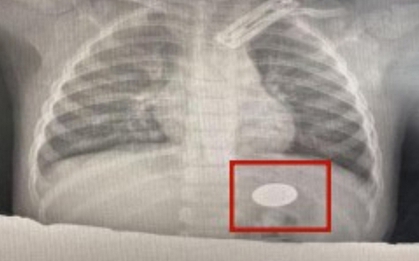 Đưa con trai đi điều trị viêm phổi, cha mẹ sốc nặng khi bác sĩ gắp ra thứ "đáng sợ" trong dạ dày