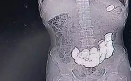 Người đàn ông 33 tuổi bụng phình to như quả bóng, bác sĩ gắp ra thứ "đáng sợ" bên trong